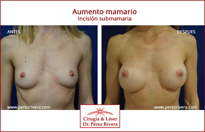 foto de antes y después