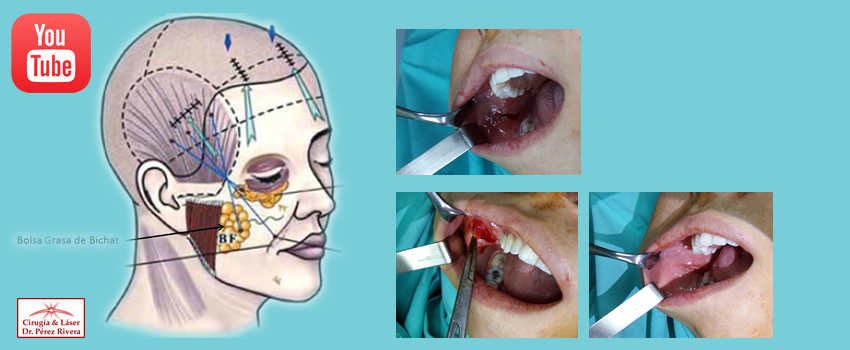 Nuevo video: Bichectomia